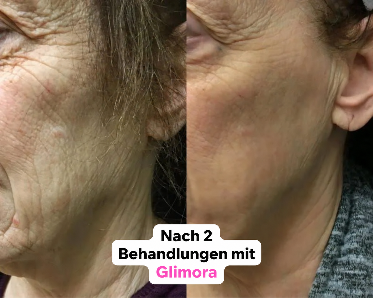 Glimora™ - Micro-Infusion Gesichtsset
