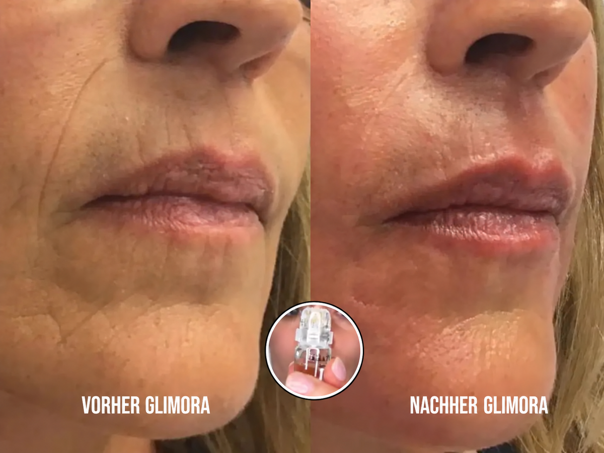 Glimora™ - Micro-Infusion Gesichtsset