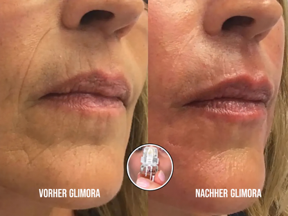 Glimora™ - Micro-Infusion Gesichtsset