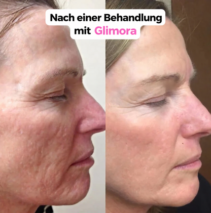 Glimora™ - Micro-Infusion Gesichtsset